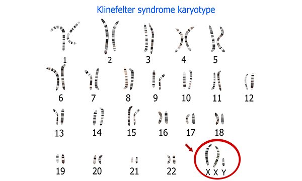 Hội chứng Klinefelter có điều trị được không?