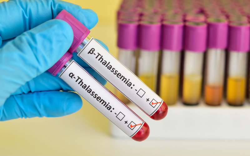 Bệnh Thalassemia tan máu bẩm sinh có điều trị được không?