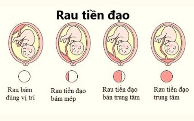 Nhau tiền đạo: nguyên nhân, triệu chứng và cách điều trị chi tiết nhất