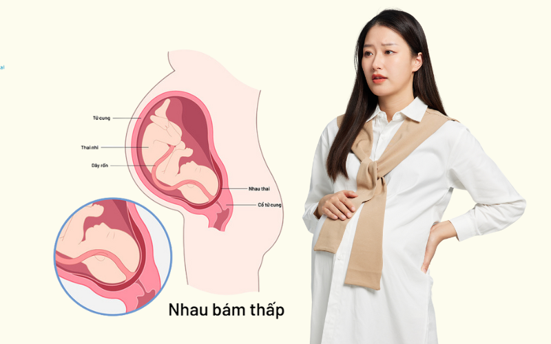 Nhau thai bám thấp có sinh thường được không?