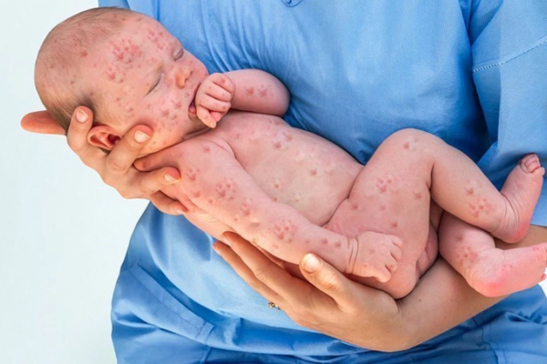 Bị thủy đậu khi mang thai khiến em bé có nguy cơ mắc hội chứng thủy đậu bẩm sinh