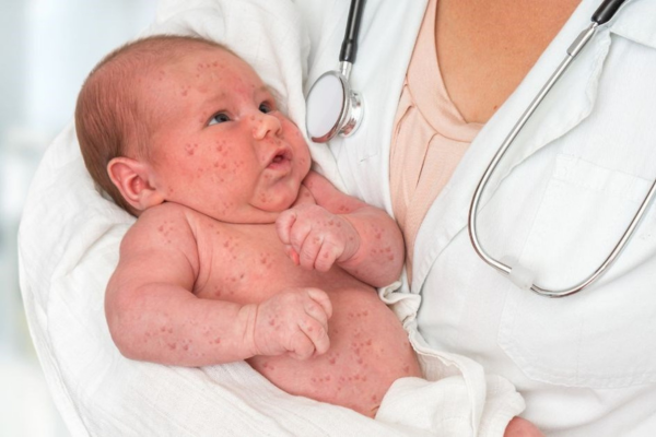 Trẻ có nguy cơ mắc hội chứng Rubella bẩm sinh nếu mẹ mắc rubella khi mang thai