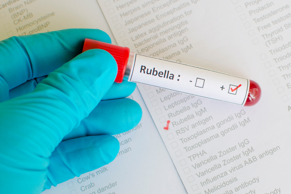 Xét nghiệm rubella