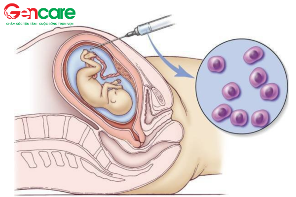 phương pháp sàng lọc trước sinh chọc ối